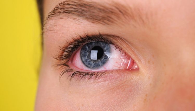 आँखा रातो हुनुलाई सामान्य मान्दा दृष्टिसमेत गुम्न सक्ने सम्भाबना हुने