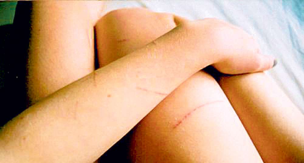 घाउचोटको खत कसरी मेटाउन सकिन्छ र यसको उपचार पध्दति कस्तो रहन सकिन्छ हेर्नुस् !