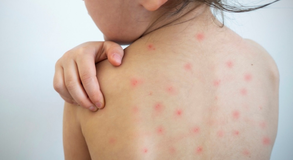 ललितपुरको कुपण्डोलमा दादुराको लक्षण भएका बिरामी भेटिए