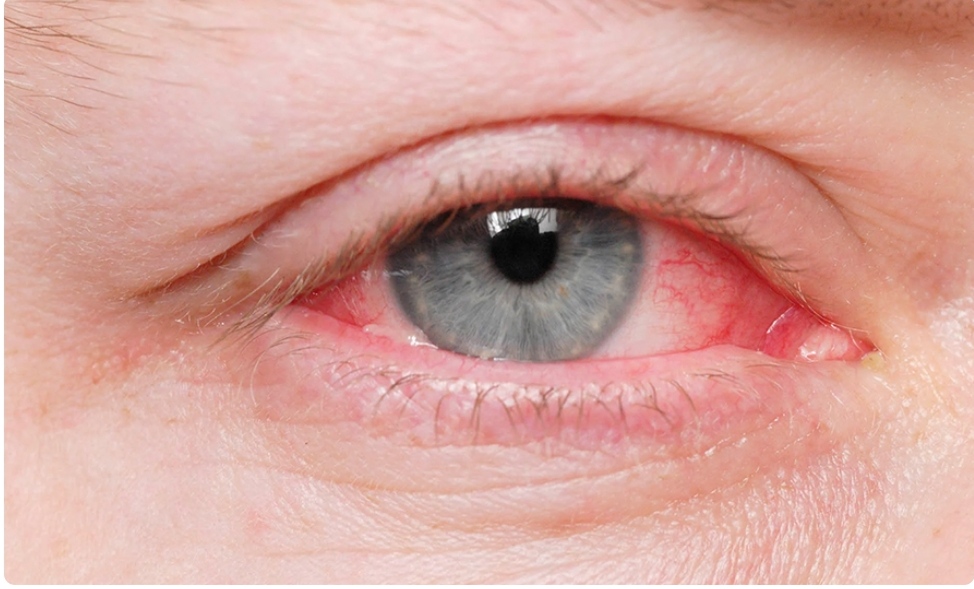 पोखराका अस्पतालले आँखाको परीक्षण र औषधि निःशुल्क प्रदान गर्न थाल्यो